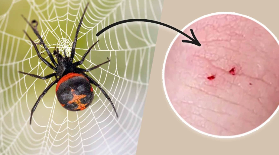black widow bite