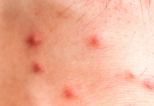 signs of flea infestation