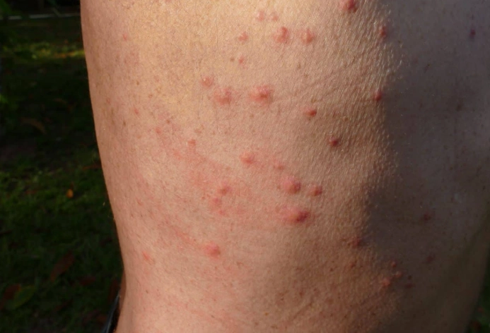 identify bed bug bites