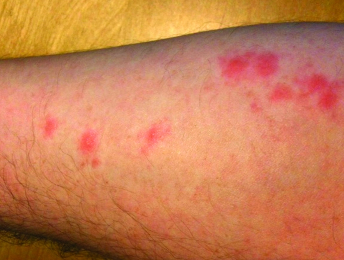 bed bug bites