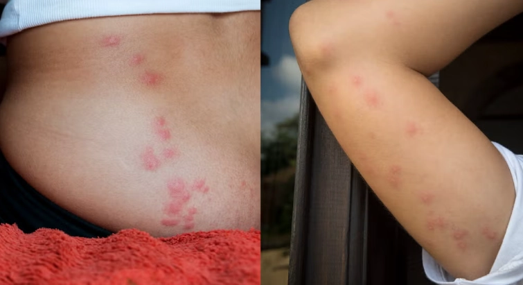 bed bug bites