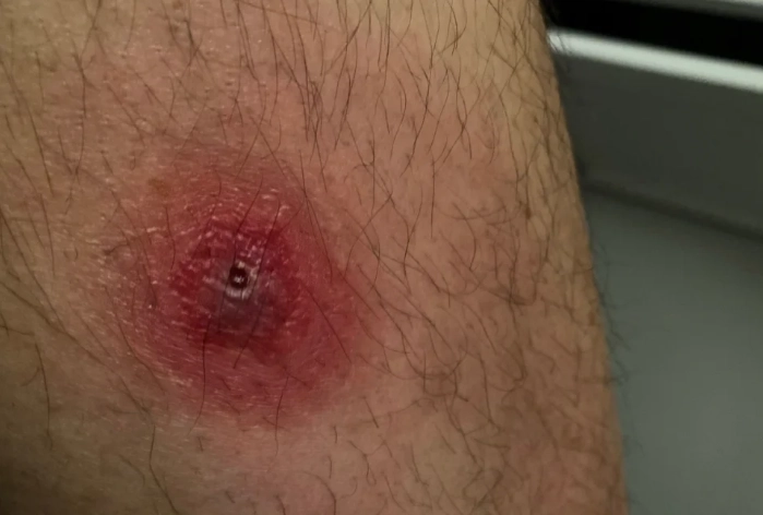 salticidae bite treatment