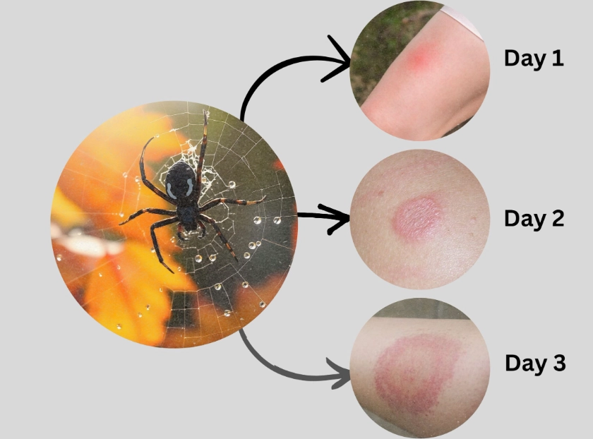 spider bite treatment