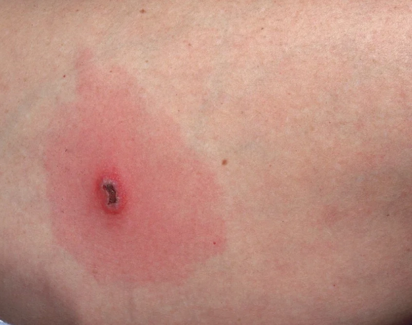 how to treat a spider bite at home