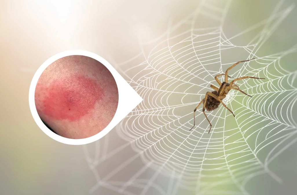 bedroom spider bite symptoms