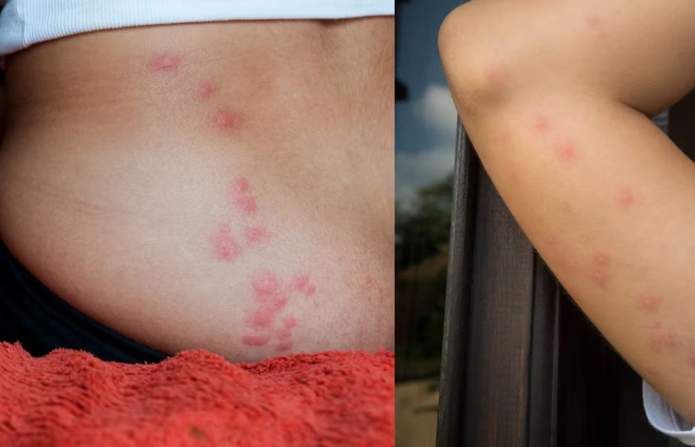 how to treat bed bug bites how to treat bed bug bites