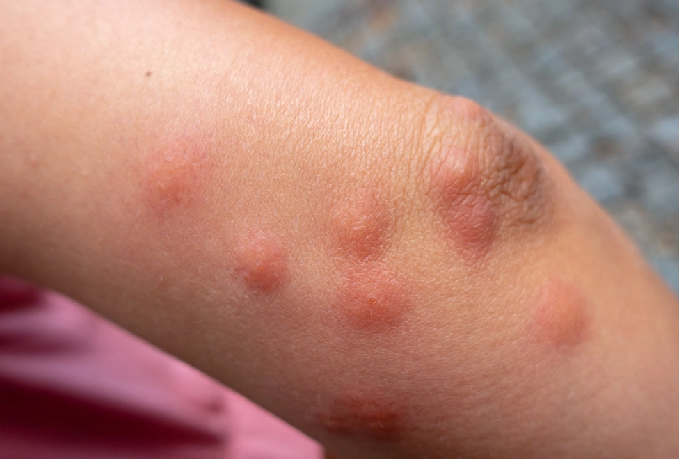 bed bug bites bed bug bites