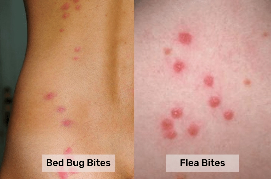 how to treat flea bites how to treat flea bites
