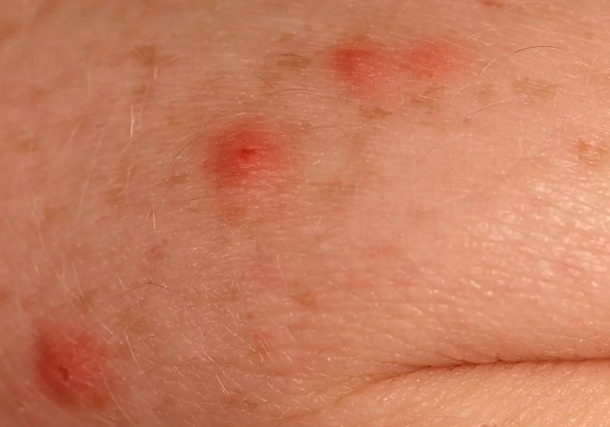 bedbug bites