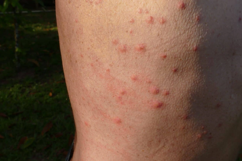 bed bug bites vs flea bites bed bug bites vs flea bites