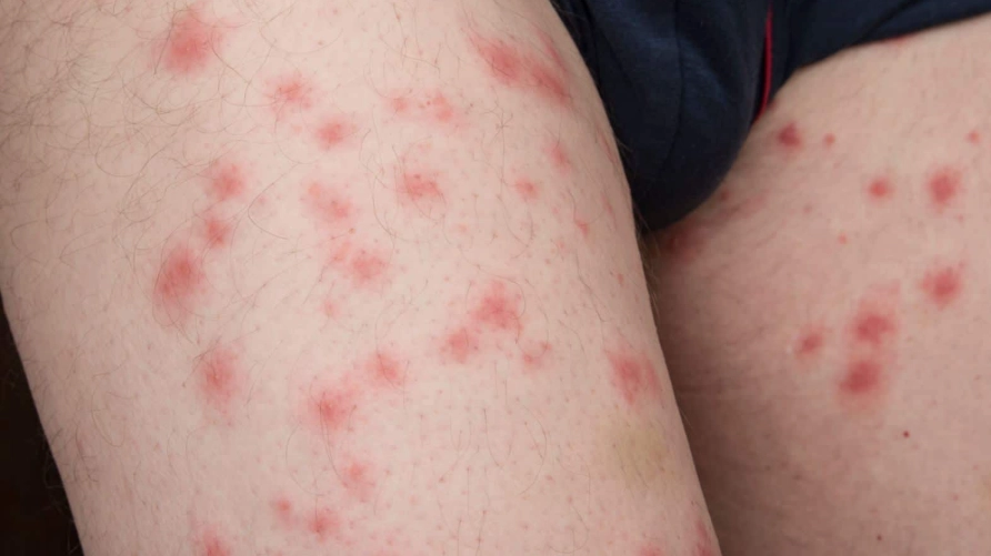 how to treat bedbug bites how to treat bedbug bites