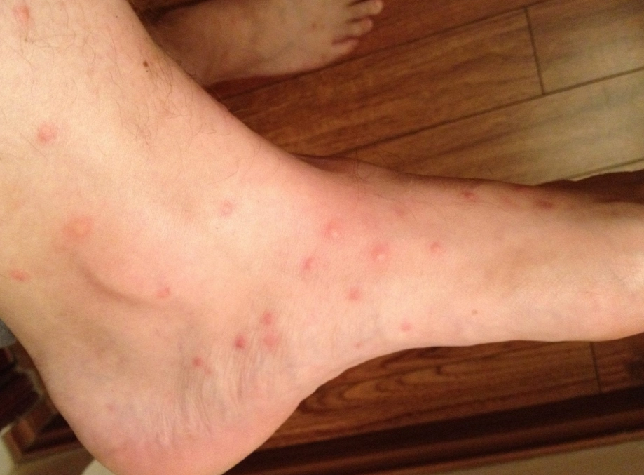 bed bug and flea bite treatment bed bug and flea bite treatment