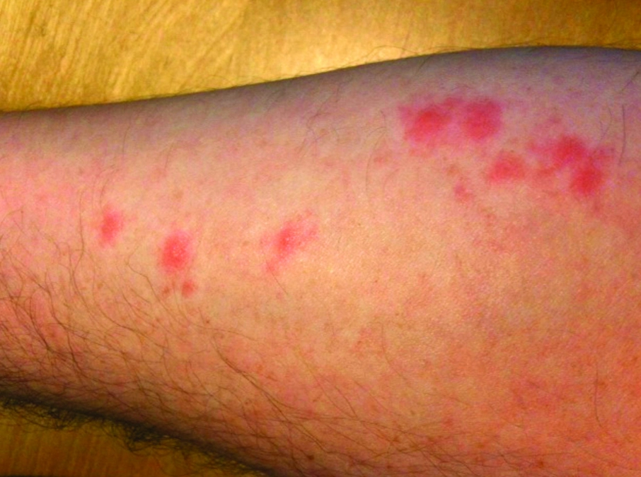 how to tell bed bug bites from flea bites how to tell bed bug bites from flea bites