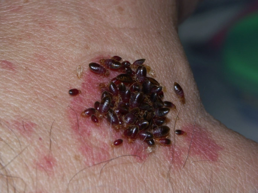 bedbug bites bedbug bites