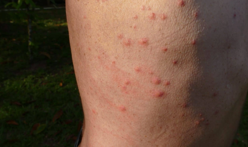bed bug bite symptoms bed bug bite symptoms