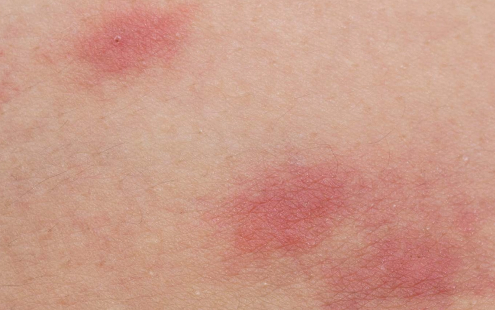 bed bug and flea bite treatment bed bug and flea bite treatment