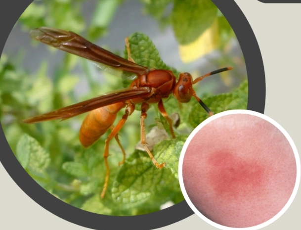 paper wasp sting treatment
