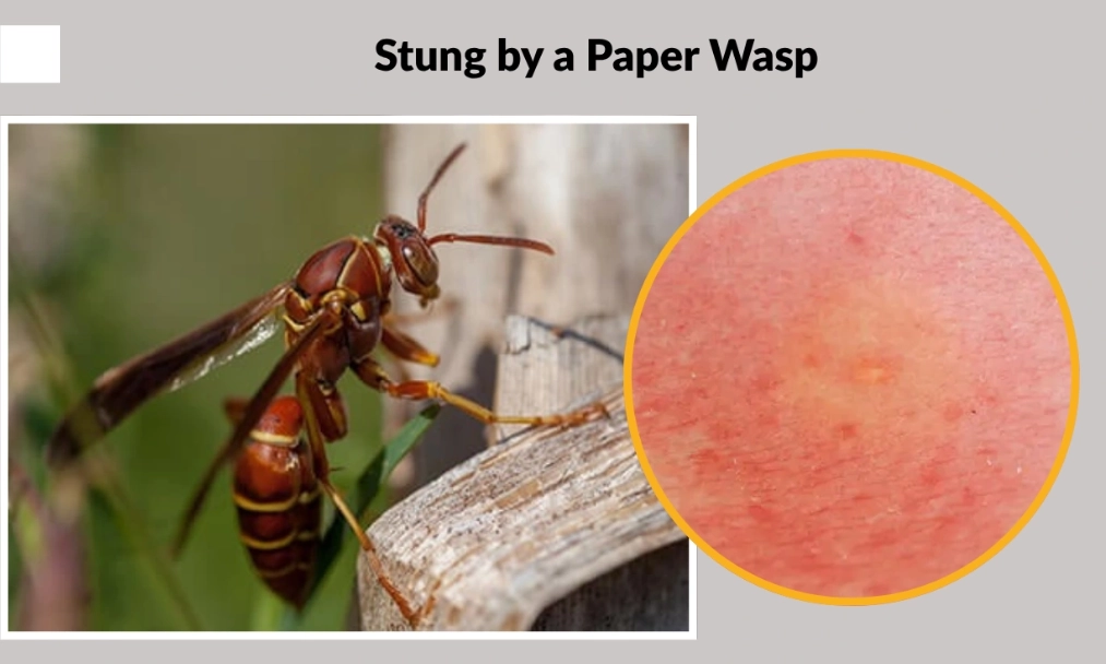 paper wasp sting allergic reaction