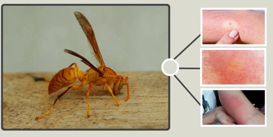 paper wasp sting allergic reaction
